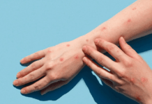 Се испитува примерокот за мајмунски сипаници од сомнителен пациент мајмунски сипаници