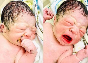 Бебе се родило заедно со контрацептивна спирала