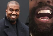 Kanye West Titanium dentures